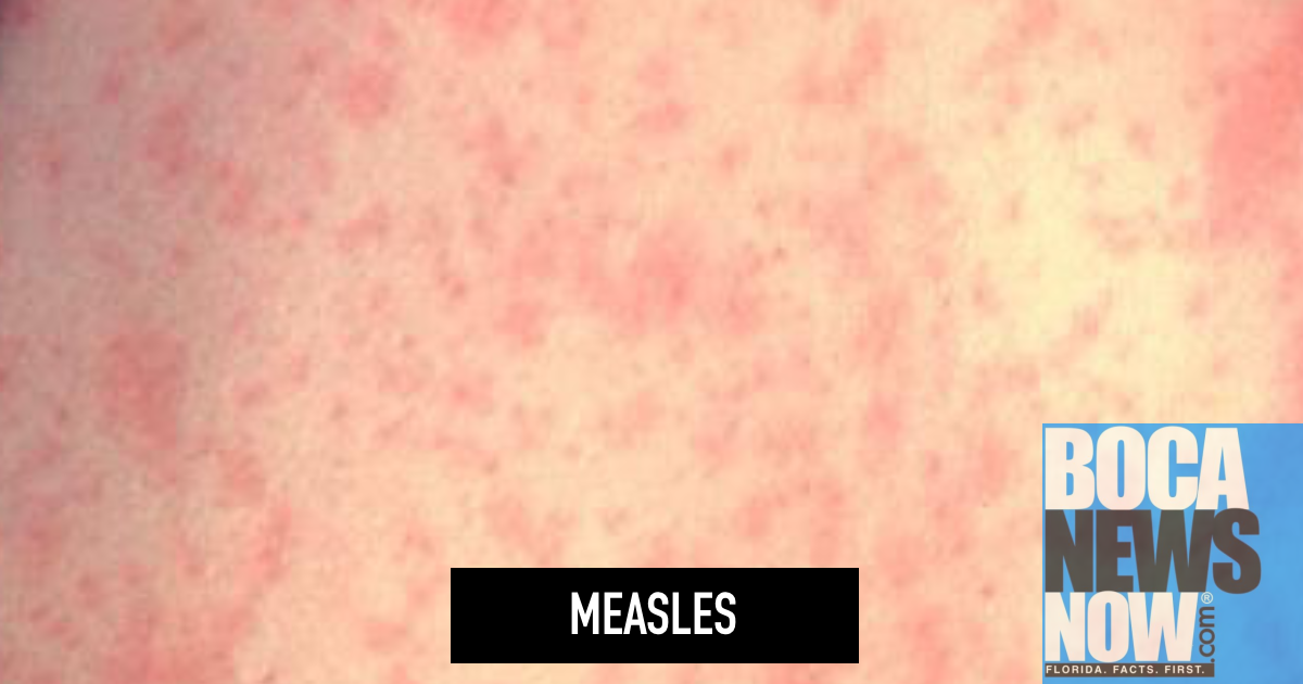 Measles Florida